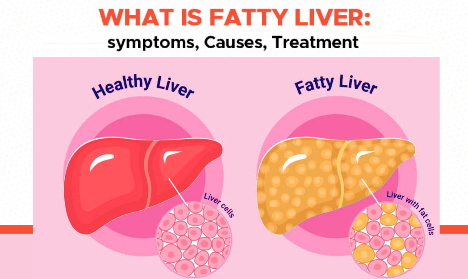 What to Know About  Fatty Liver Grade 1 and Fatty Liver Grade 2 Causes, Symptoms, and Treatment