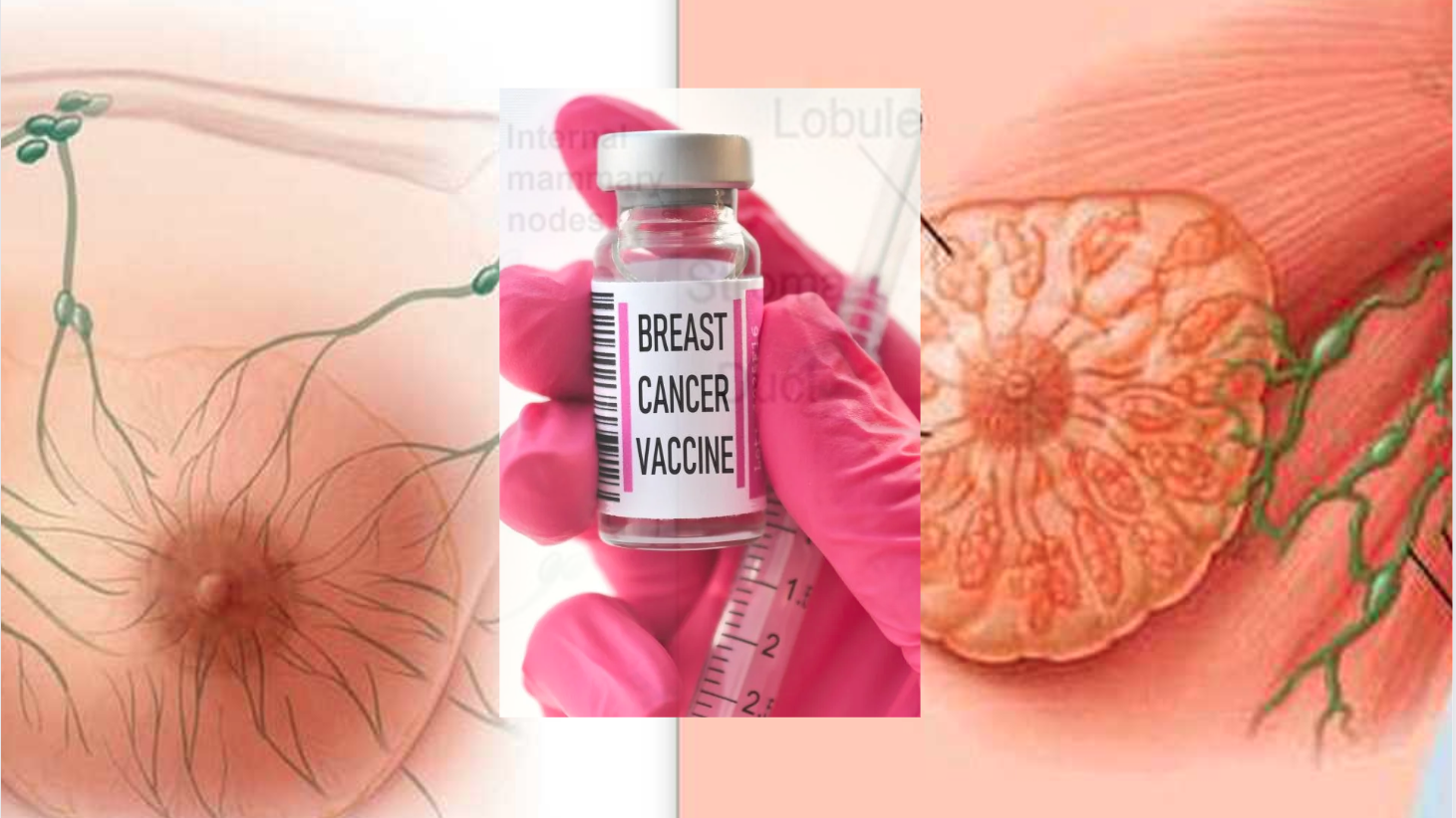 Breast Cancer Vaccine Hope for Women's Health