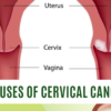 The Hidden causes of cervical cancer Simple Insights