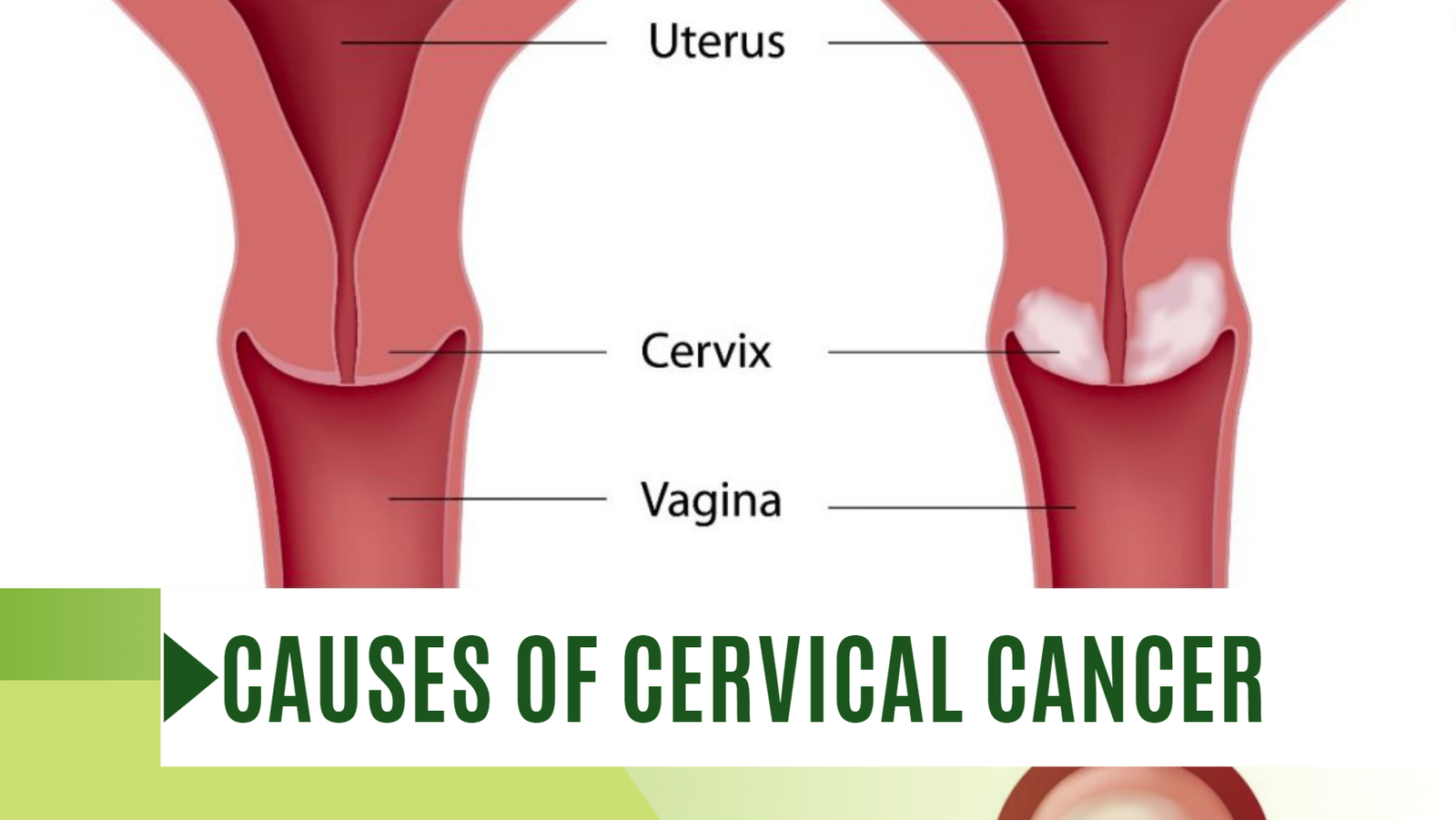 The Hidden causes of cervical cancer Simple Insights