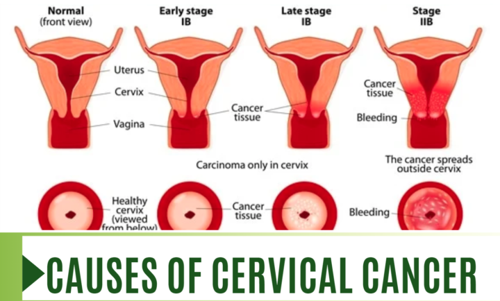 The Hidden causes of cervical cancer1
